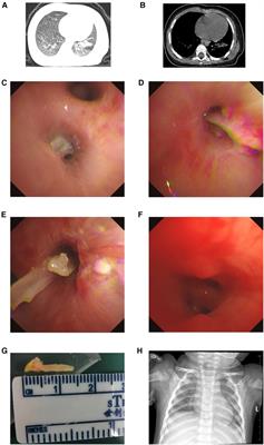 A combination of flexible and rigid bronchoscopy in the successful removal of a residual fish bone from a peripheral bronchus: A case report